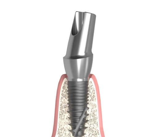 Pilastro dentale per impianto conico - Actival - Bionika Medline Kft. - in titanio / esagonale / interno