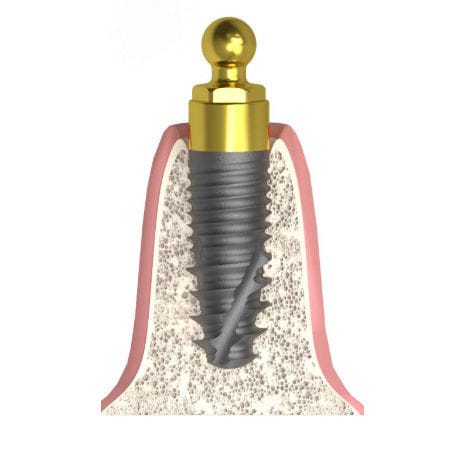 Pilastro dentale per impianto cilindrico - Actival - Bionika Medline Kft. - sferico / dritto / per clinica odontoiatrica