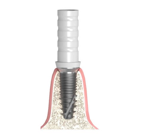 Pilastro dentale per impianto cilindrico conico - Actival - Bionika Medline Kft. - in titanio / in plastica / interno