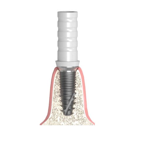 Pilastro dentale per impianto in plastica - Actival - Bionika Medline Kft. - cilindrico conico / CoCr / interno