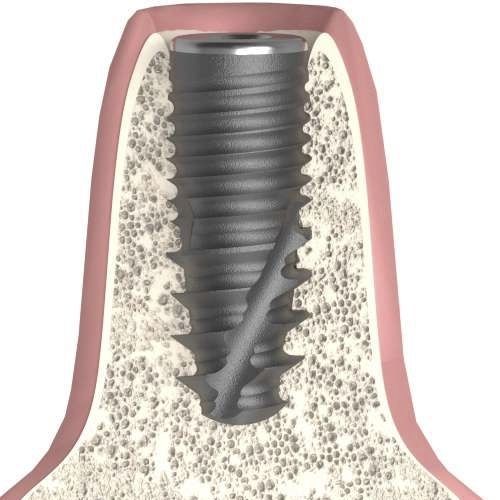 Impianto dentale cilindrico conico - UNIFORM - Bionika Medline Kft. - in titanio / esagonale / interno