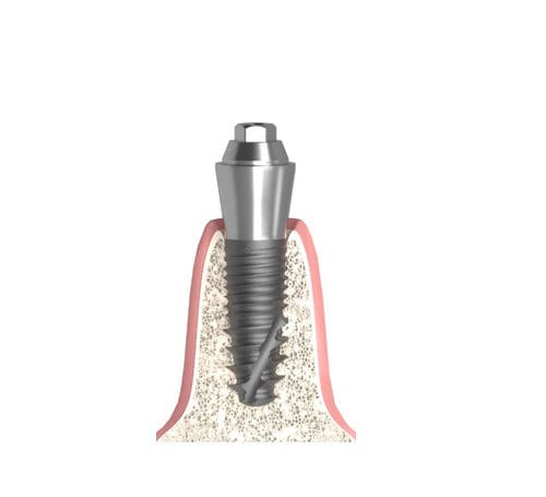 Pilastro dentale per impianto cilindrico conico - Actival - Bionika Medline Kft. - conico / interno / multi-unità