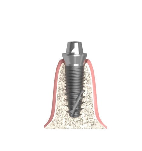 Pilastro dentale per impianto cilindrico conico - Actival - Bionika Medline Kft. - conico / interno / dritto