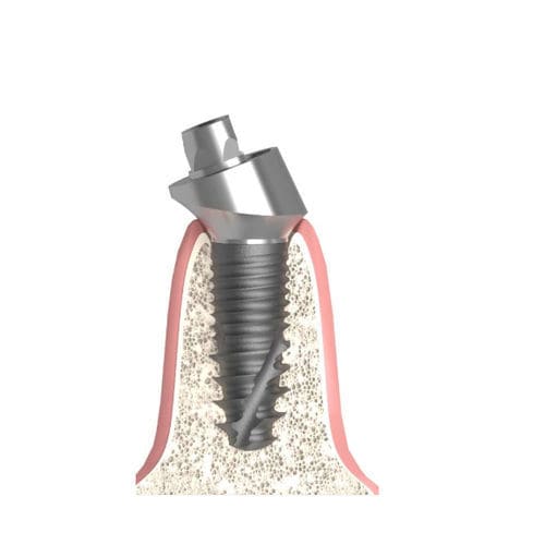 Pilastro dentale per impianto cilindrico conico - 517.894.300.010 - Bionika Medline Kft. - interno / angolare / multi-unità