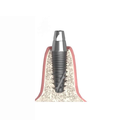 Pilastro dentale per impianto conico - Actival - Bionika Medline Kft. - esterno / dritto / multi-unità
