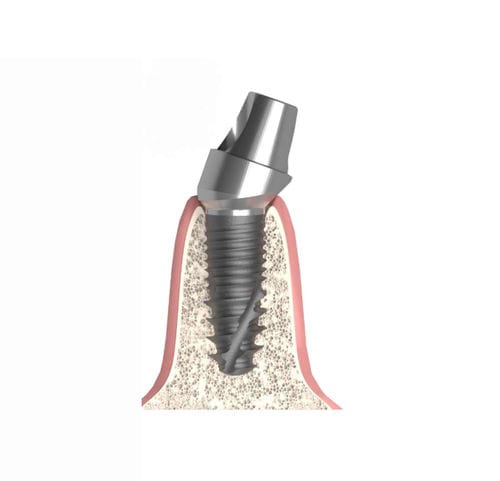 Pilastro dentale per impianto cilindrico conico - Actival - Bionika Medline Kft. - interno / angolare / multi-unità