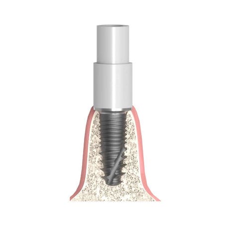 Pilastro dentale per impianto cilindrico conico - Actival - Bionika Medline Kft. - in titanio / in plastica / interno