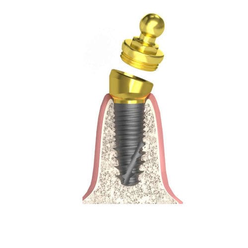 Pilastro dentale per impianto cilindrico conico - Actival - Bionika Medline Kft. - conico / interno / sferico