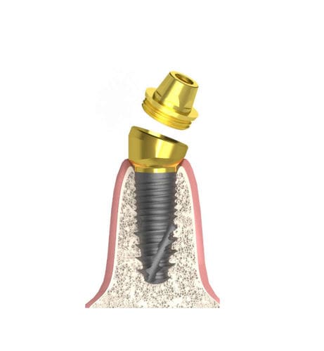 Pilastro dentale per impianto conico - Actival - Bionika Medline Kft. - conico / interno / angolare