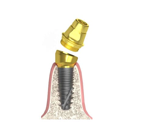 Pilastro dentale per impianto conico - Actival - Bionika Medline Kft. - in titanio / conico / interno