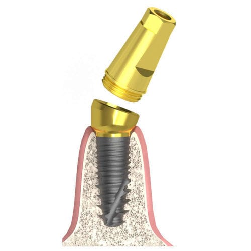 Pilastro dentale per impianto conico - Actival - Bionika Medline Kft. - conico / interno / a vite