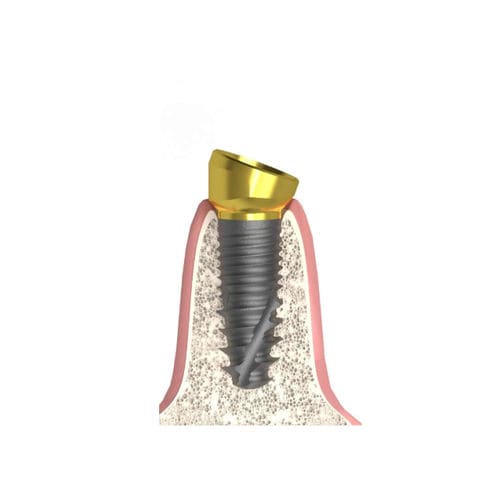 Pilastro dentale per impianto cilindrico conico - Actival - Bionika Medline Kft. - in titanio / conico / interno