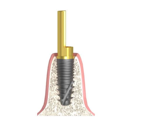 Pilastro dentale per impianto cilindrico - Bioplant - Bionika Medline Kft. - in titanio / esagonale / interno