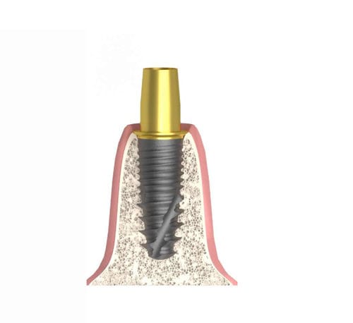 Pilastro dentale per impianto cilindrico - Bioplant - Bionika Medline Kft. - in titanio / esagonale / interno