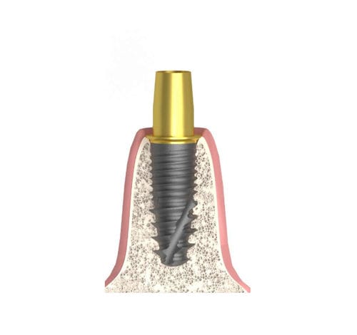 Pilastro dentale per impianto cilindrico conico - UNIFORM DIO® UF - Bionika Medline Kft. - in titanio / interno / dritto