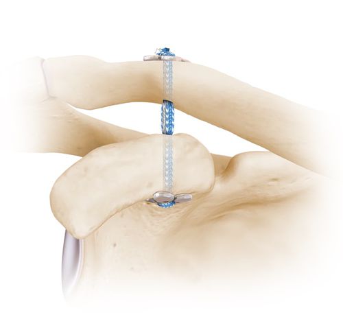 Bottone da sutura per ricostruzione del legamento acromio-clavicolare - Arthraction