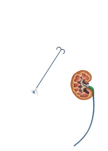 Guaina di accesso ureterale - FY series - Hunan Endovascular Device Co., Ltd. - renale / orientabile / atraumatica