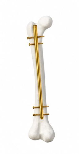 Chiodo intramidollare per omero - 10110 series - hb ortho - in titanio