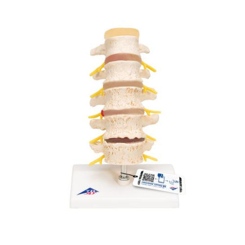 Modello anatomico di vertebre - A795  - 3B Scientific   - ad uso didattico / di ernia / disarticolato