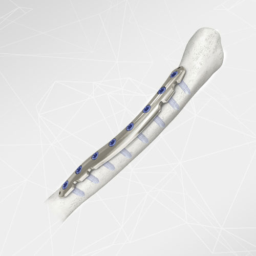 Placca di compressione per clavicola - LOQTEQ® 2.7 - aap Implantate - laterale / mediale / bloccata