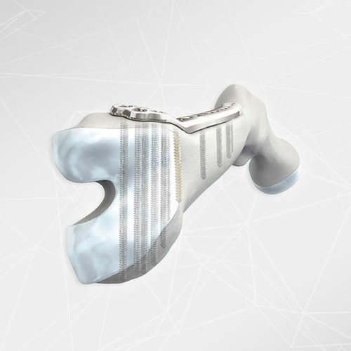 Placca di compressione per femore - LOQTEQ® 4.5 - aap Implantate - distale / laterale / bloccata