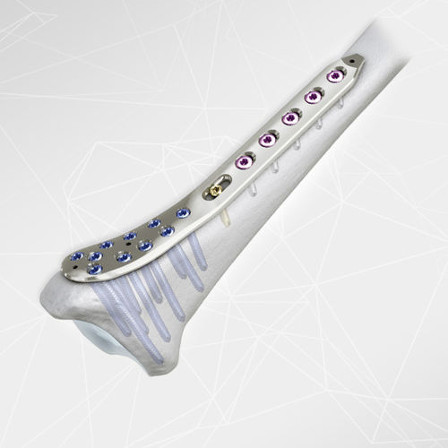 Placca di compressione per tibia -  LOQTEQ® 3.5 - aap Implantate - distale / mediale / bloccata
