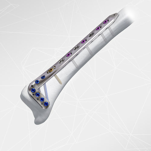 Placca di compressione per tibia -  LOQTEQ® 3.5 - aap Implantate - distale / anterolaterale / bloccata
