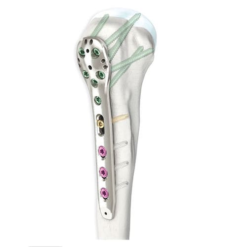 Placca di compressione per omero - LOQTEQ® 3.5 - aap Implantate - prossimale / bloccata / in metallo