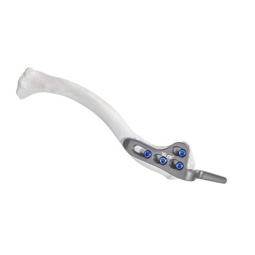 Placca di compressione per clavicola - 10-54604 - AF Medical   - laterale / bloccata / in metallo
