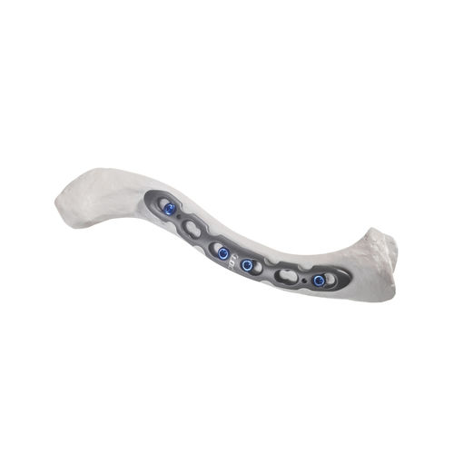 Placca di compressione per clavicola - 10-54766 - AF Medical   - anterolaterale / bloccata / in metallo