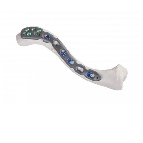 Placca di compressione per clavicola - 10-54813 - AF Medical   - anterolaterale / bloccata / in metallo