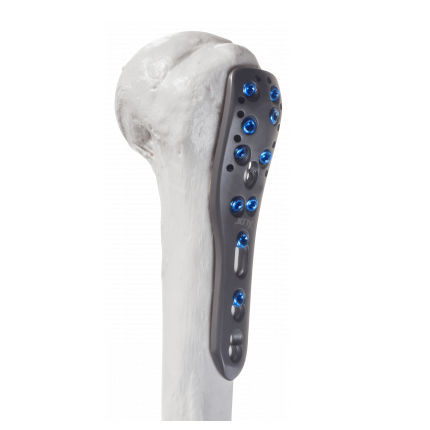 Placca di compressione per omero - 10-54003 - AF Medical   - prossimale / bloccata / in metallo