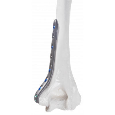 Placca di compressione per omero - 10-54103 - AF Medical   - distale / mediale / bloccata