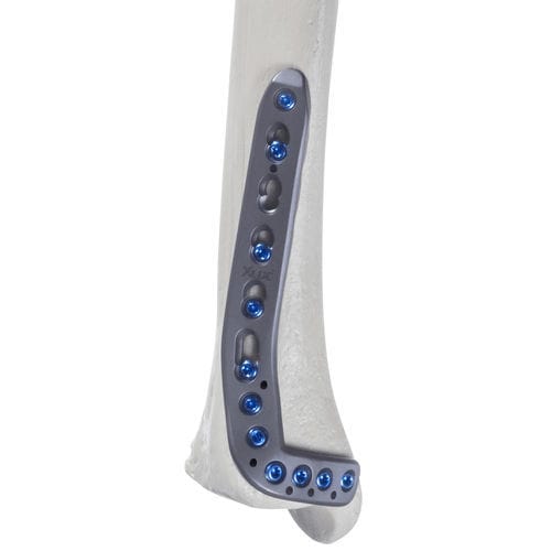 Placca di compressione per tibia - 10-55 series - AF Medical   - distale / anterolaterale / bloccata