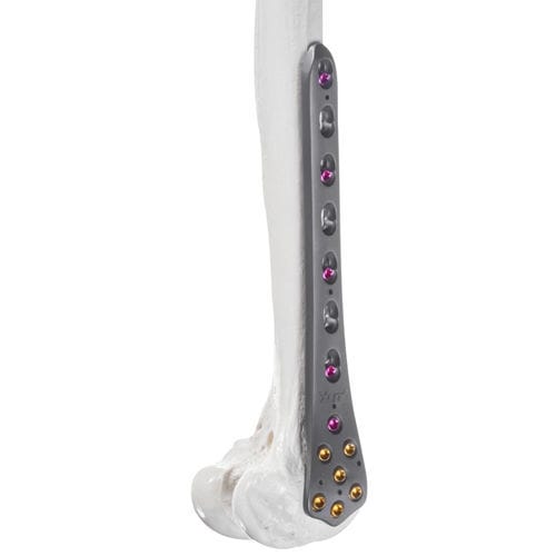 Placca di compressione per femore - 10-63105 - AF Medical   - distale / bloccata / in metallo