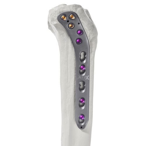 Placca di compressione per tibia - 10-62603 - AF Medical   - prossimale / laterale / bloccata