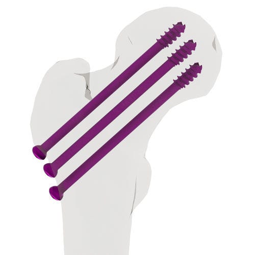Vite per compressione ossea per polso - 15-02800 - AF Medical   - per tibia / per femore / femorale