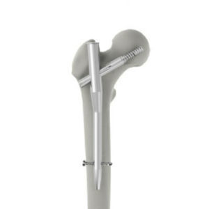 Chiodo intramidollare per femore - INTERNA® PFN - BAUMER  - fissazione prossimale / in metallo
