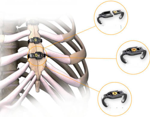 Filo per cerchiaggio ortopedico per chiusura dello sterno - Sternalink™  - Waston medical - monofilamento metallico