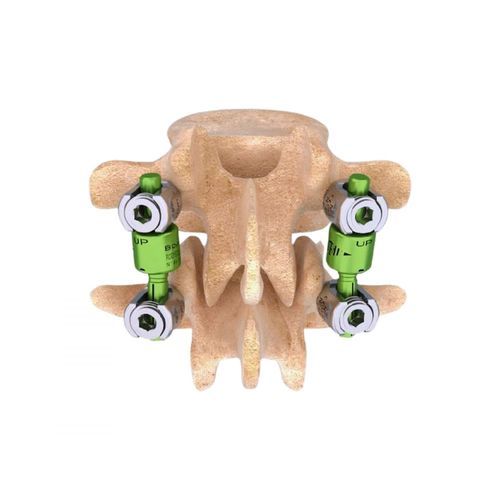Sistema di osteosintesi toraco-lombo-sacrale - BDYN - Cousin Biotech - via posteriore / per adulti