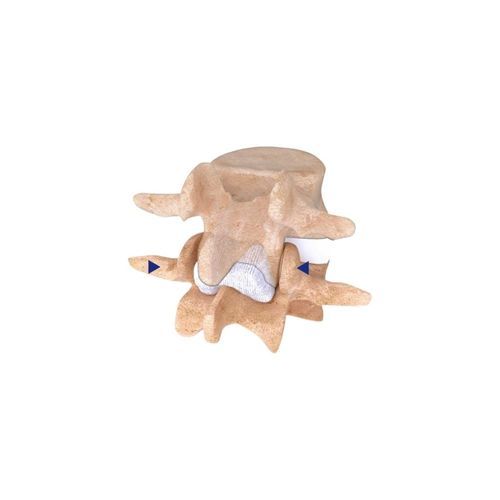 Impianto vertebrale interspinale lombare - IntraSPINE&reg; - Cousin Biotech
