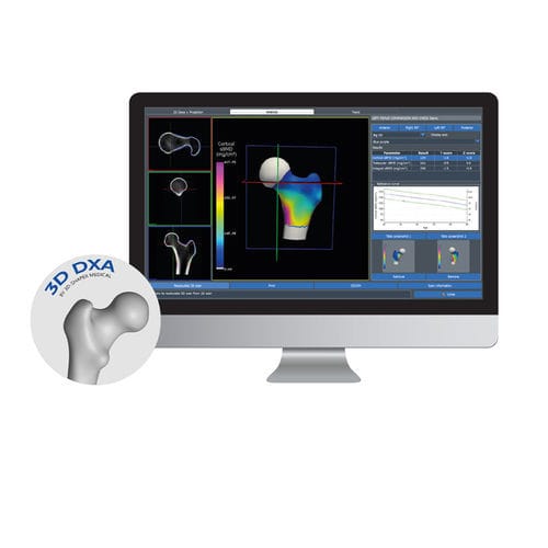 Software per osteodensitometria - 3D-DXA - DMS Imaging - di visualizzazione 3D