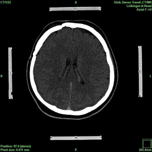 Software di pianificazione - iPS - inomed Medizintechnik - di verifica / per neurochirurgia / per neurochirurgia stereotassica