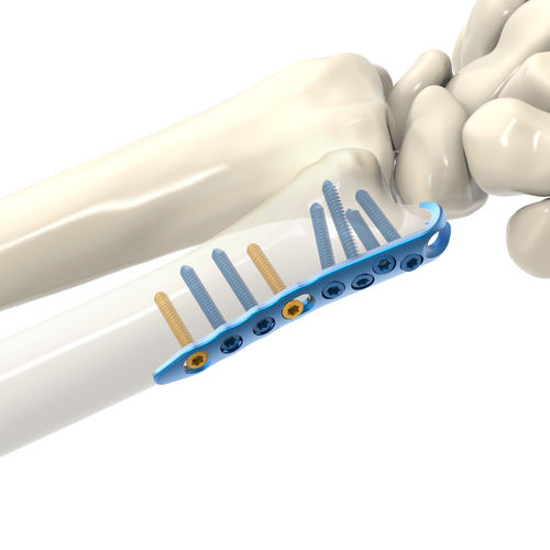Placca di compressione per ulna - ARIX 2.0 - Jeil Medical Corporation - distale / bloccata / in titanio