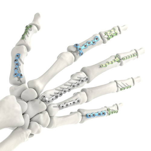 Placca di compressione per falange della mano - Jeil Medical Corporation - per metacarpo / bloccata / in titanio