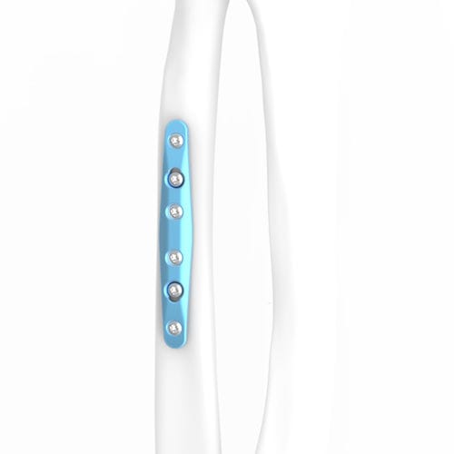 Placca per osteotomia per ulna - ARIX 2.8 - Jeil Medical Corporation - mediale / bloccata / in titanio