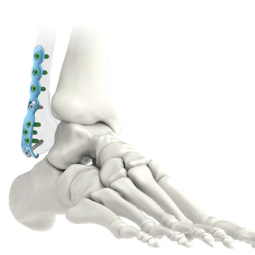 Placca di compressione per fibula - ARIX 3.5 - Jeil Medical Corporation - distale / laterale / bloccata