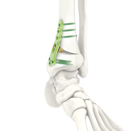 Placca per osteotomia per tibia - ARIX 3.5 - Jeil Medical Corporation - distale / bloccata / in titanio