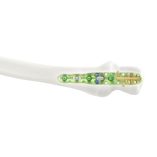 Placca di compressione per olecrano - Jeil Medical Corporation - prossimale / bloccata / in titanio