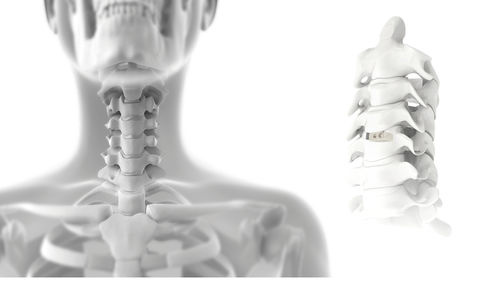 Gabbia intersomatica cervicale - FIX-C - Jeil Medical Corporation - via anteriore / in PEEK